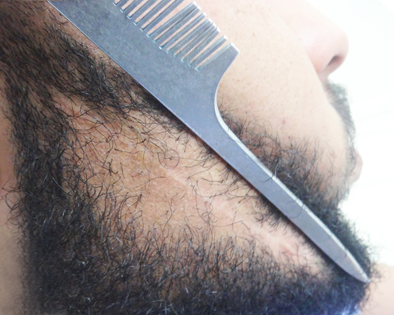 Docteur Meddeb - Correction cicatrice barbe , 21 ans, Tunisie, 608 ...